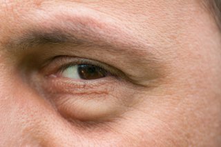 Chirurgie des paupières : un effet spectaculaire et durable