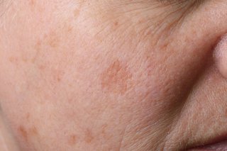 Le peeling dépigmentant pour venir à bout des taches