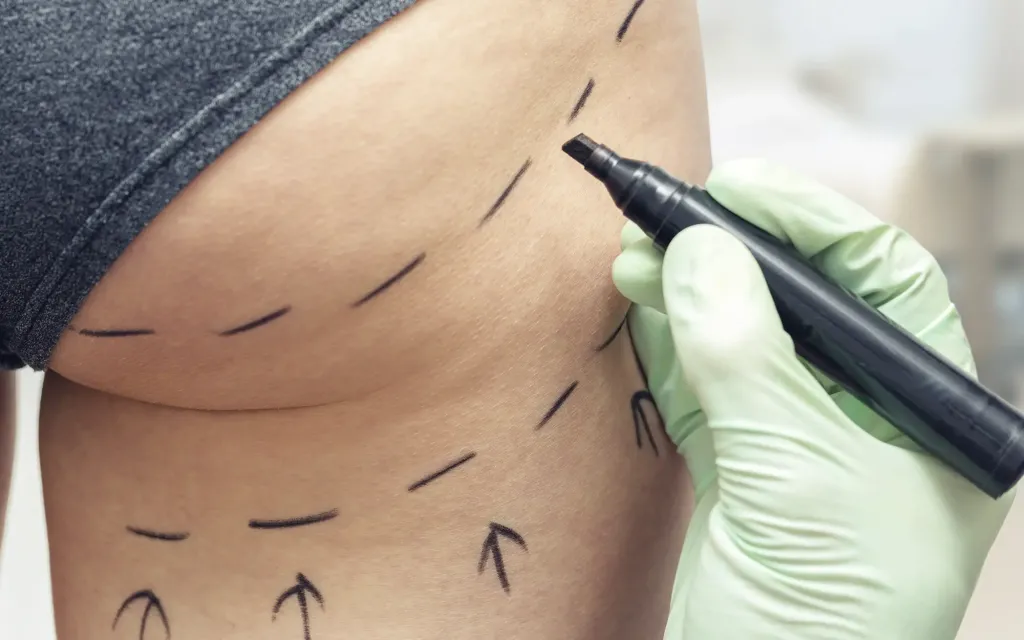 Lipoaspiration des fesses à Marseille