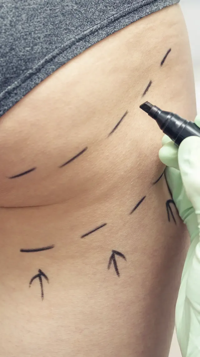 Lipoaspiration des fesses