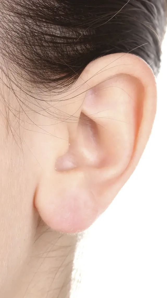 Otoplastie