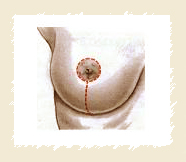 Lifting des seins méthode verticale