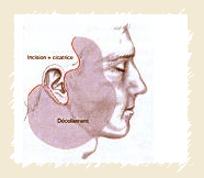 Lifting cervico facial