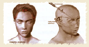 Incision pour le lifting fronto-temporal