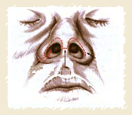 Incisions pour la rhinoplastie